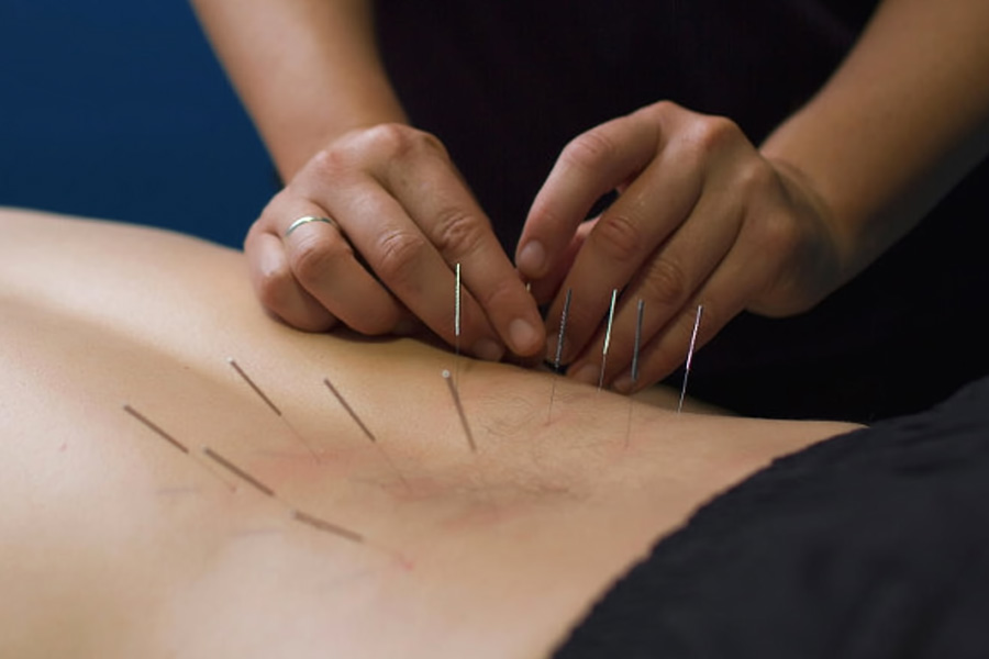 A woman getting acupuncture on her back.